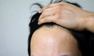 AGAが進行している男性のおでこ