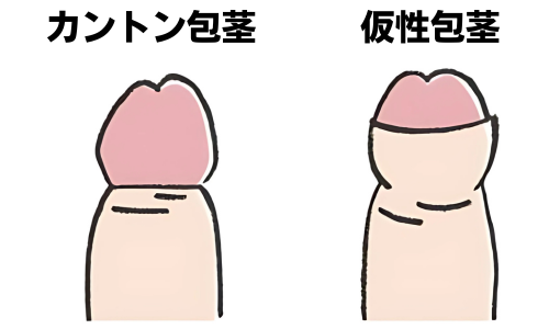 カントン包茎と仮性包茎