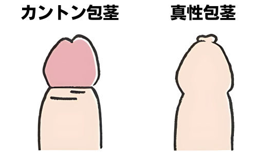 カントン包茎と真性包茎