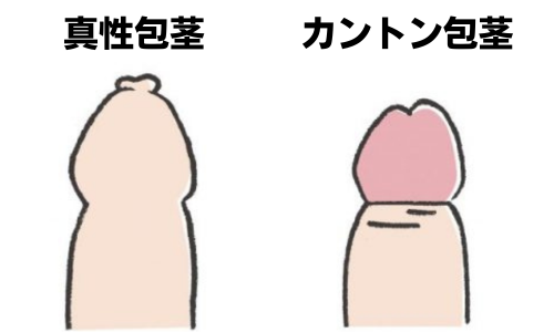 真性包茎とカントン包茎