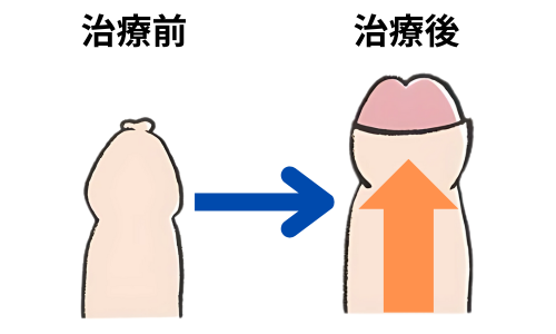 長茎術