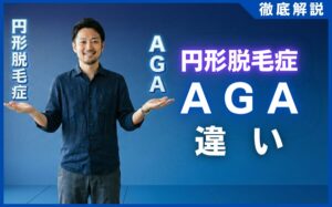 円形脱毛症とAGAの違いは？プロが教える3つの見分け方と原因